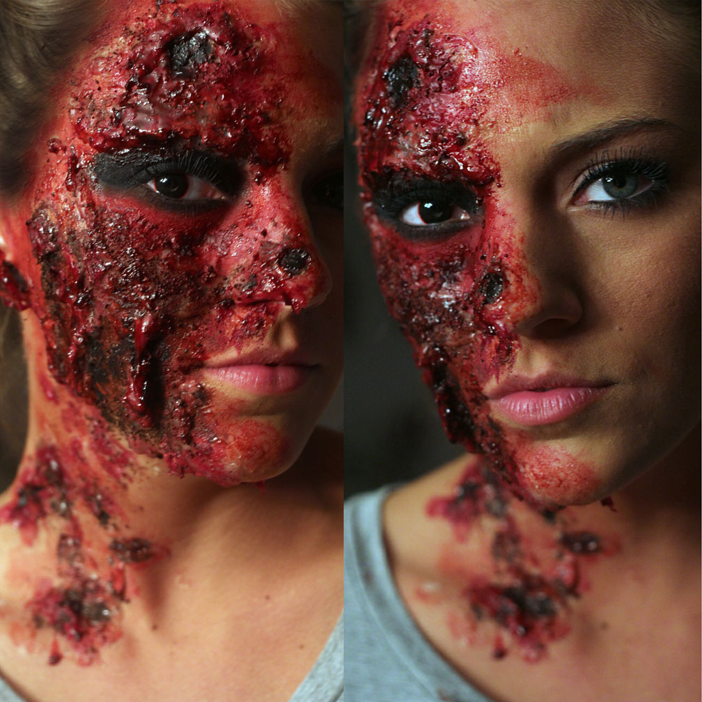 Burn face