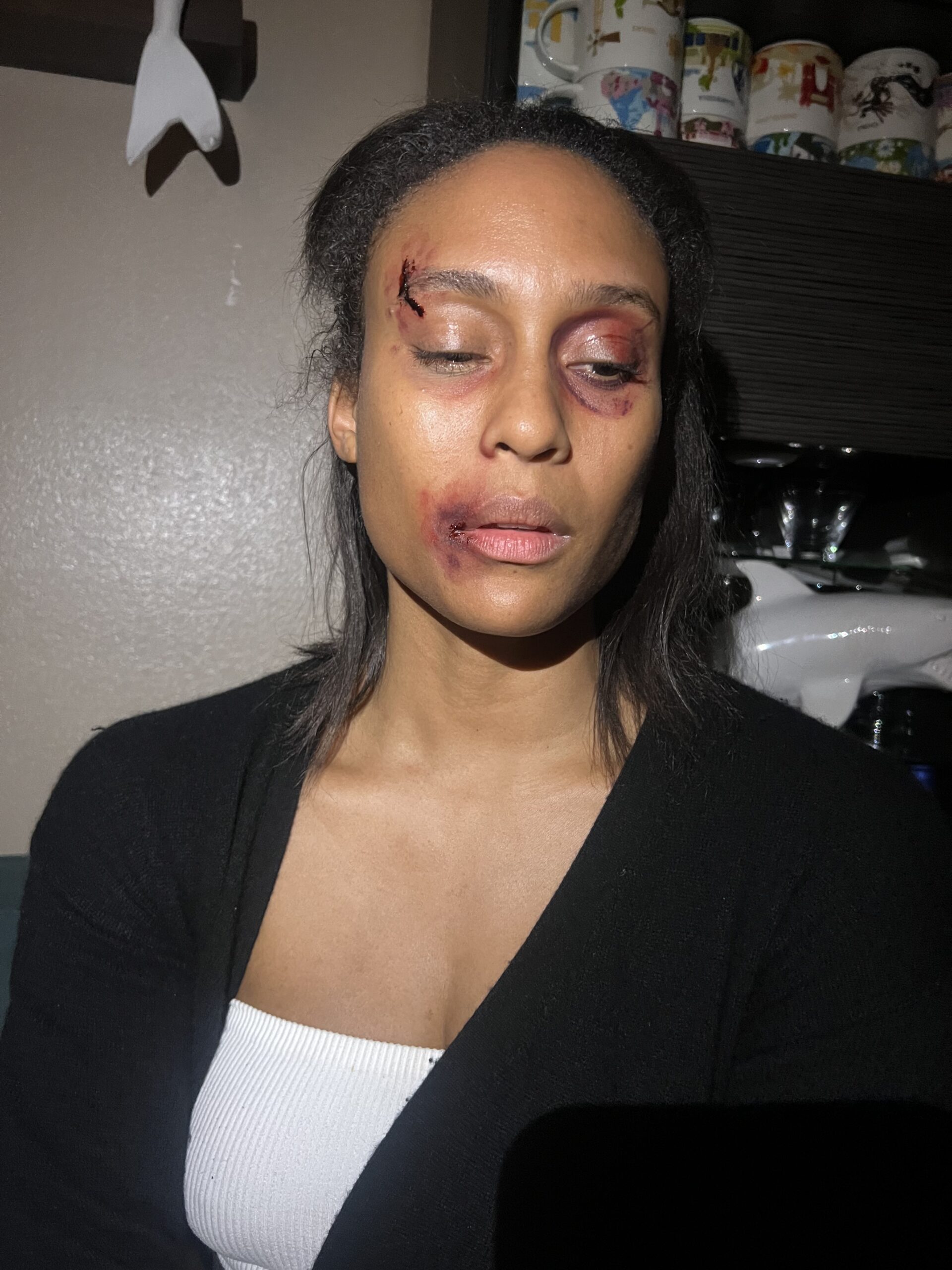 bruises