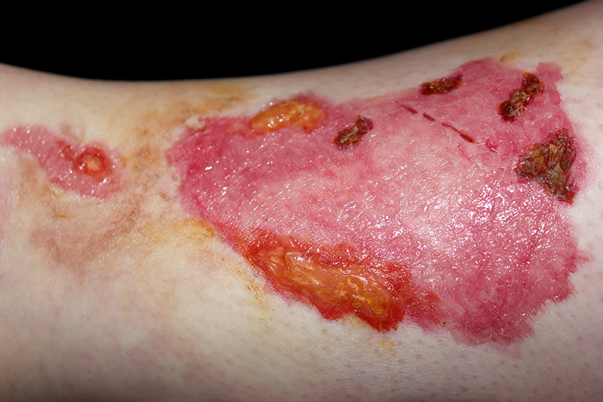 realisticburn